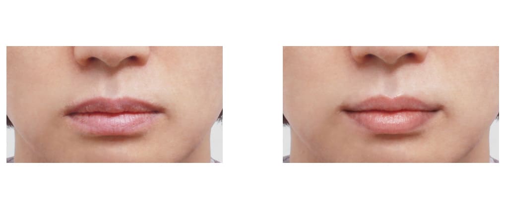 Natural Result Lip Enhancement in Korea