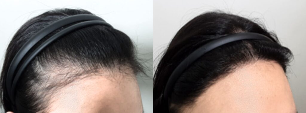 Natural results of hair transplant in Korea