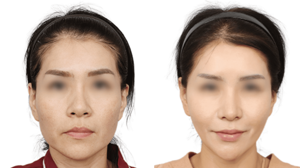 Neck thread lift_ results in Korea