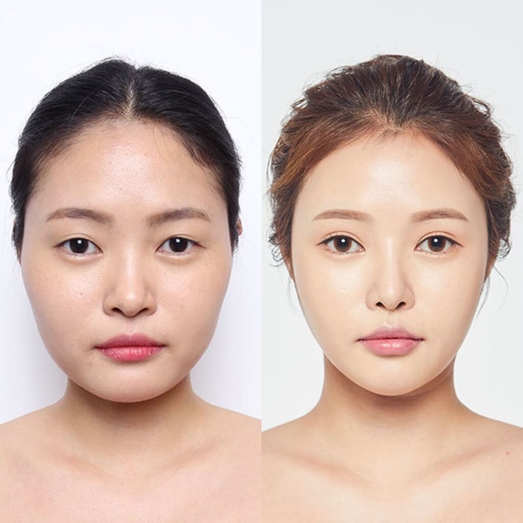 New Look for Asian Nose in Korea