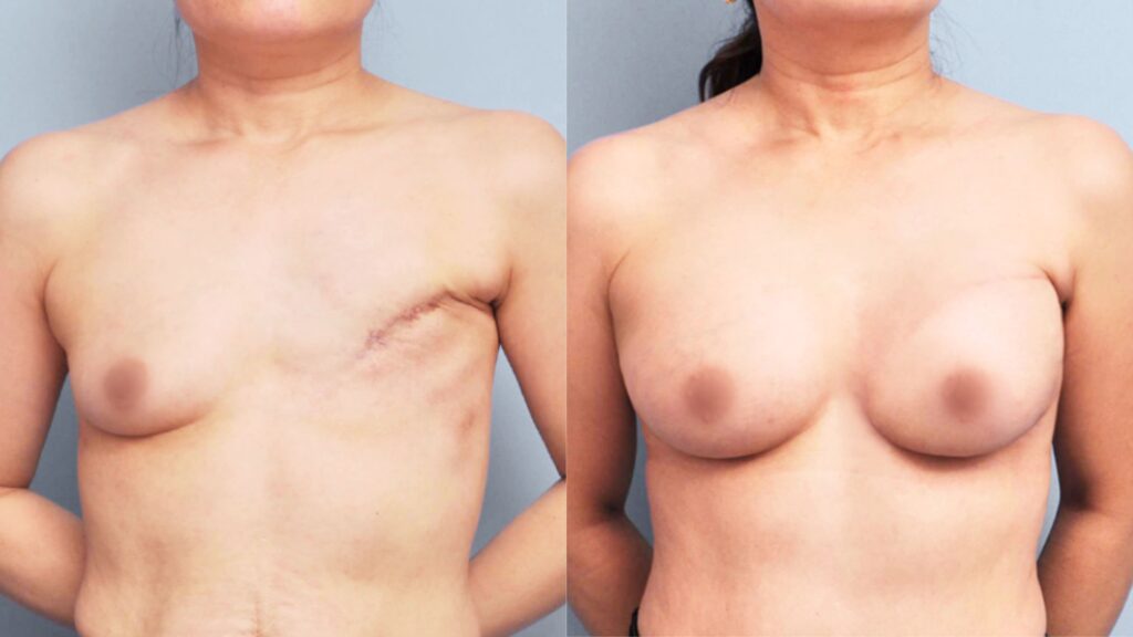 Nipple and Areola Reconstruction in Korea