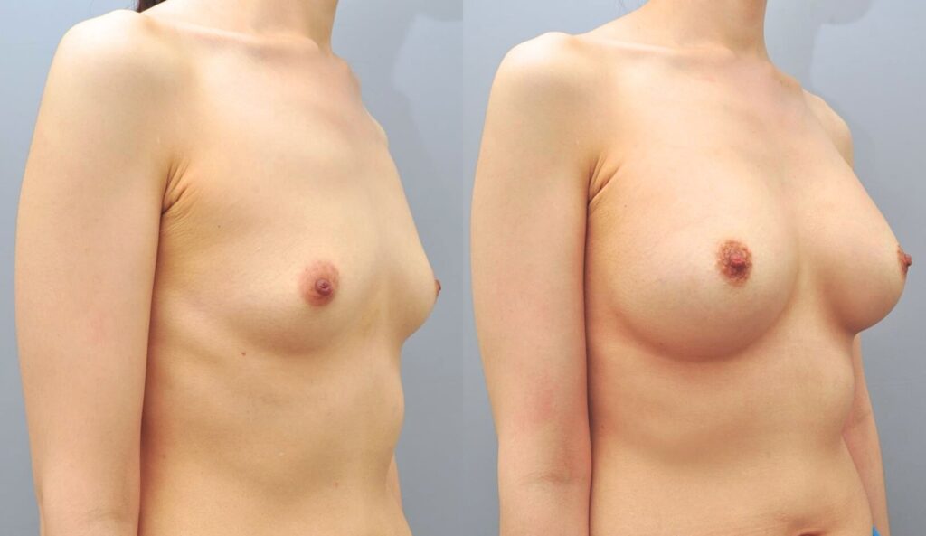 Non-Surgical Breast Enhancement_ Myths vs. Reality in Korea