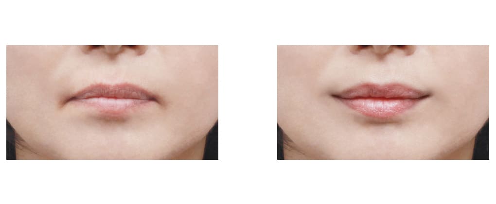 Non-injection Lip Shape Correction in Korea