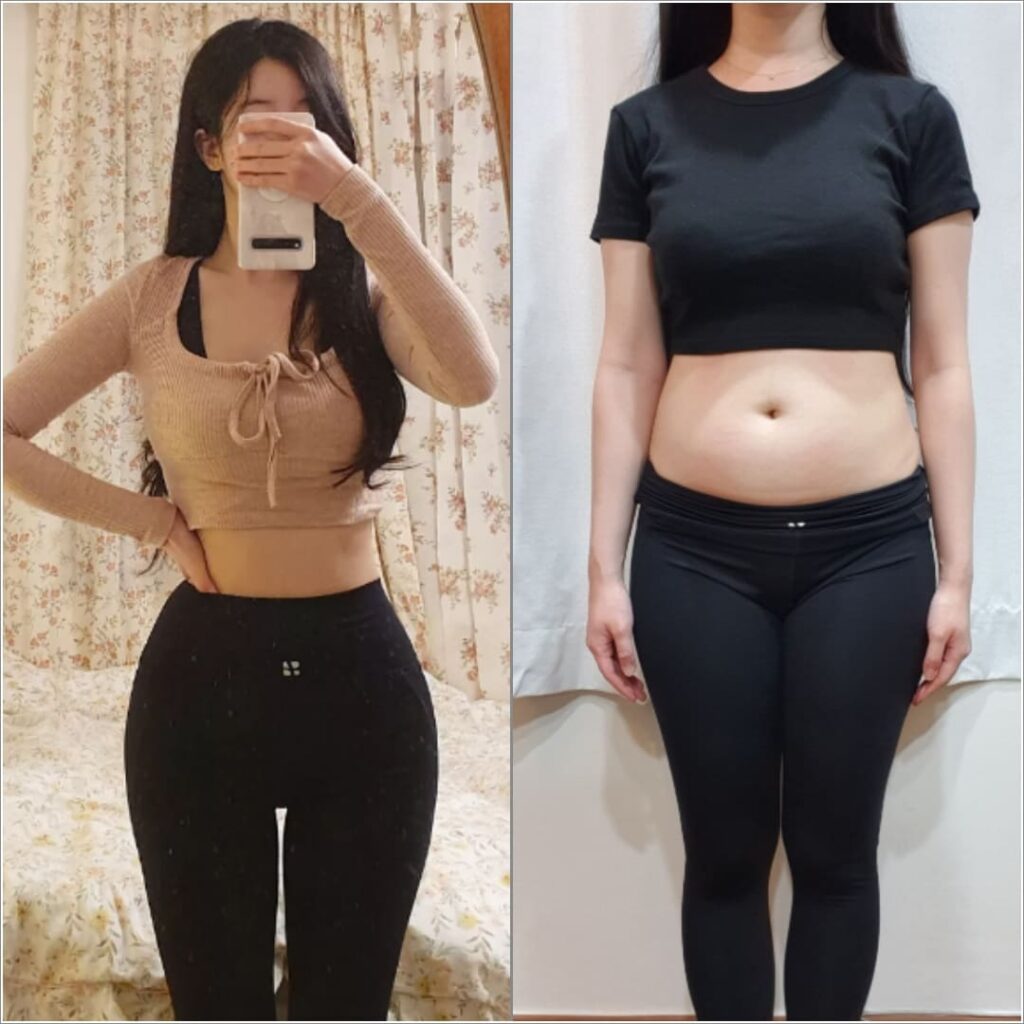 Non-surgical Abdominal Liposuction in Korea