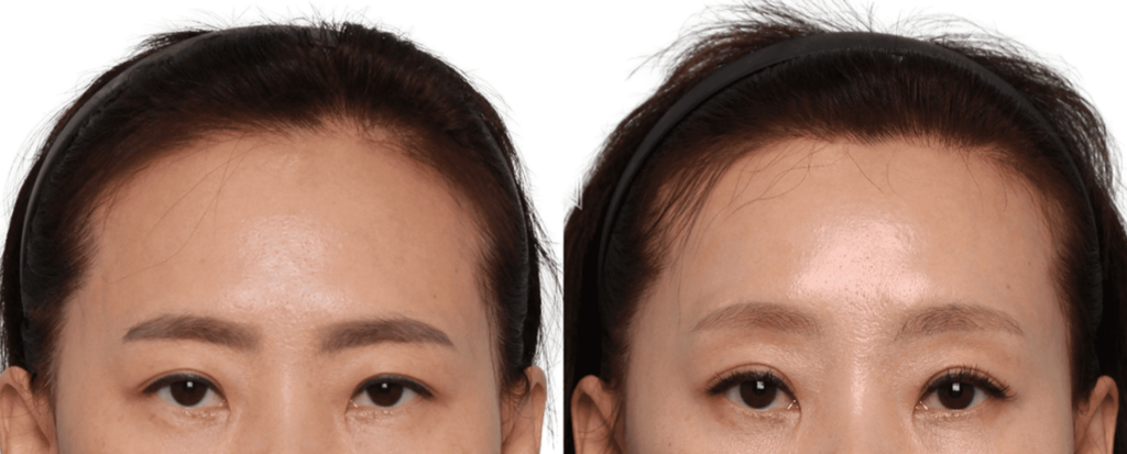 Non-surgical Forehead Lift in Korea