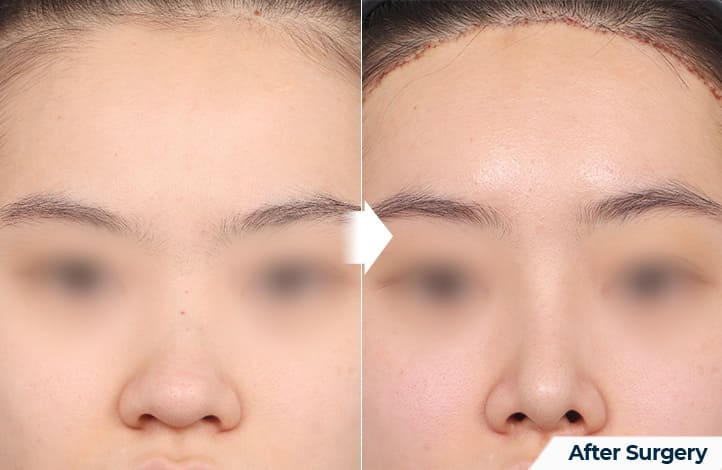 Nose Correction in Korea