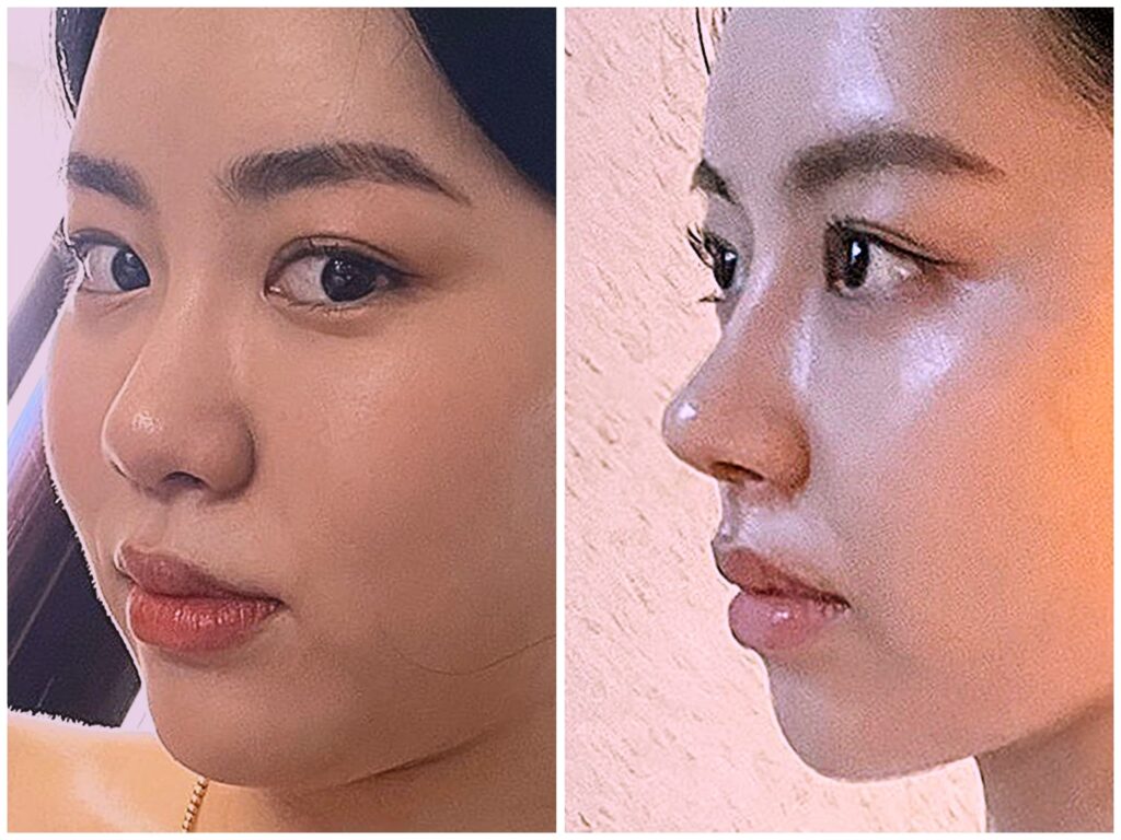 Nose Reconstruction in Korea