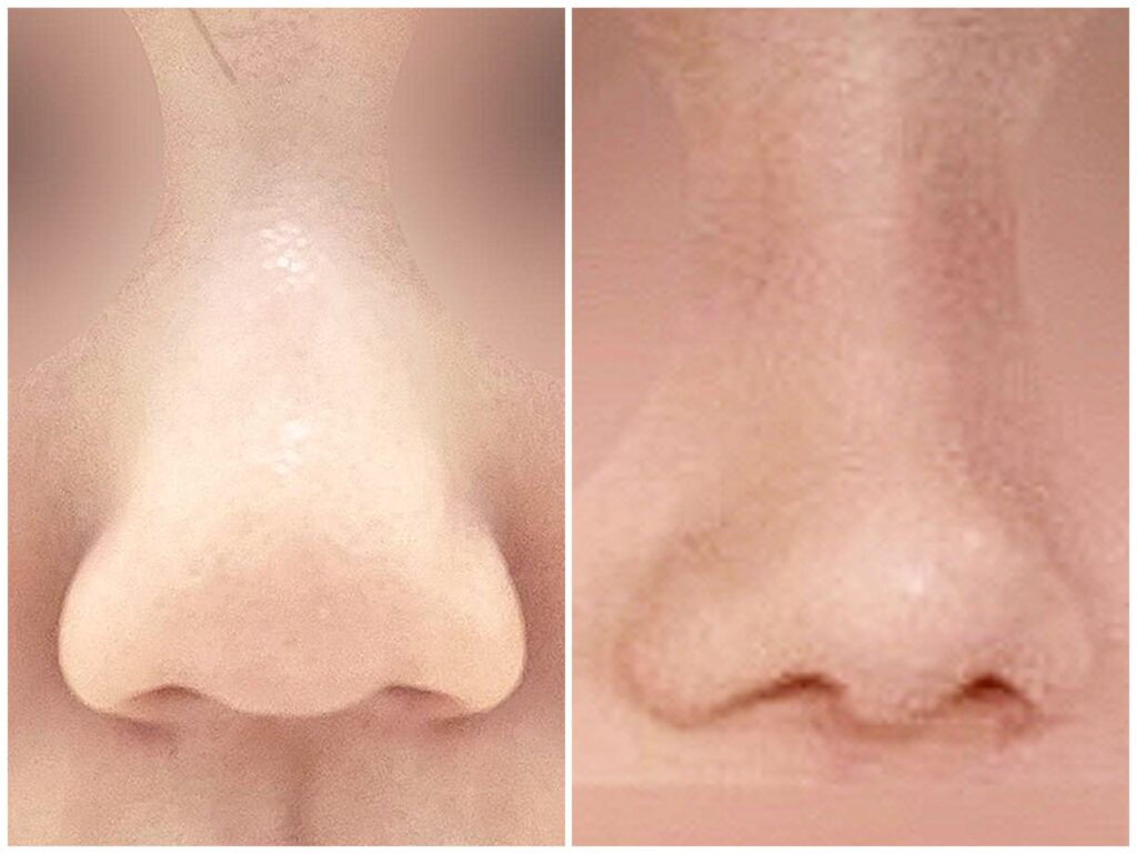 Nose Restoration in Korea