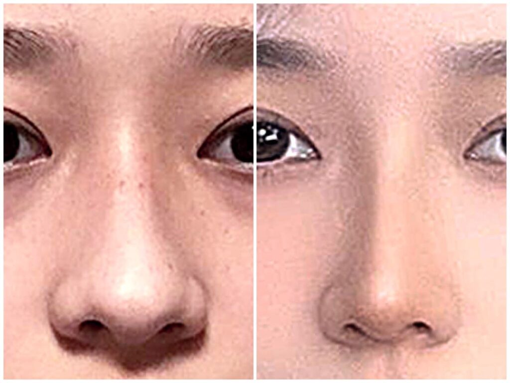 Nose Shape Modification in Korea