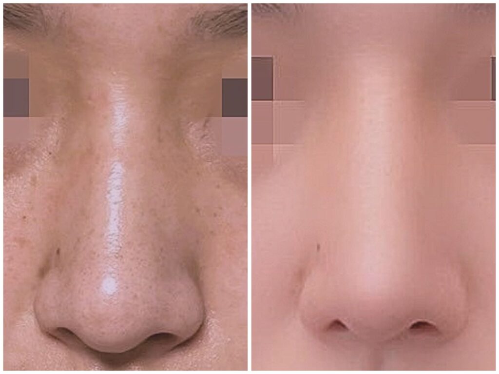 Nose Surgery in Korea