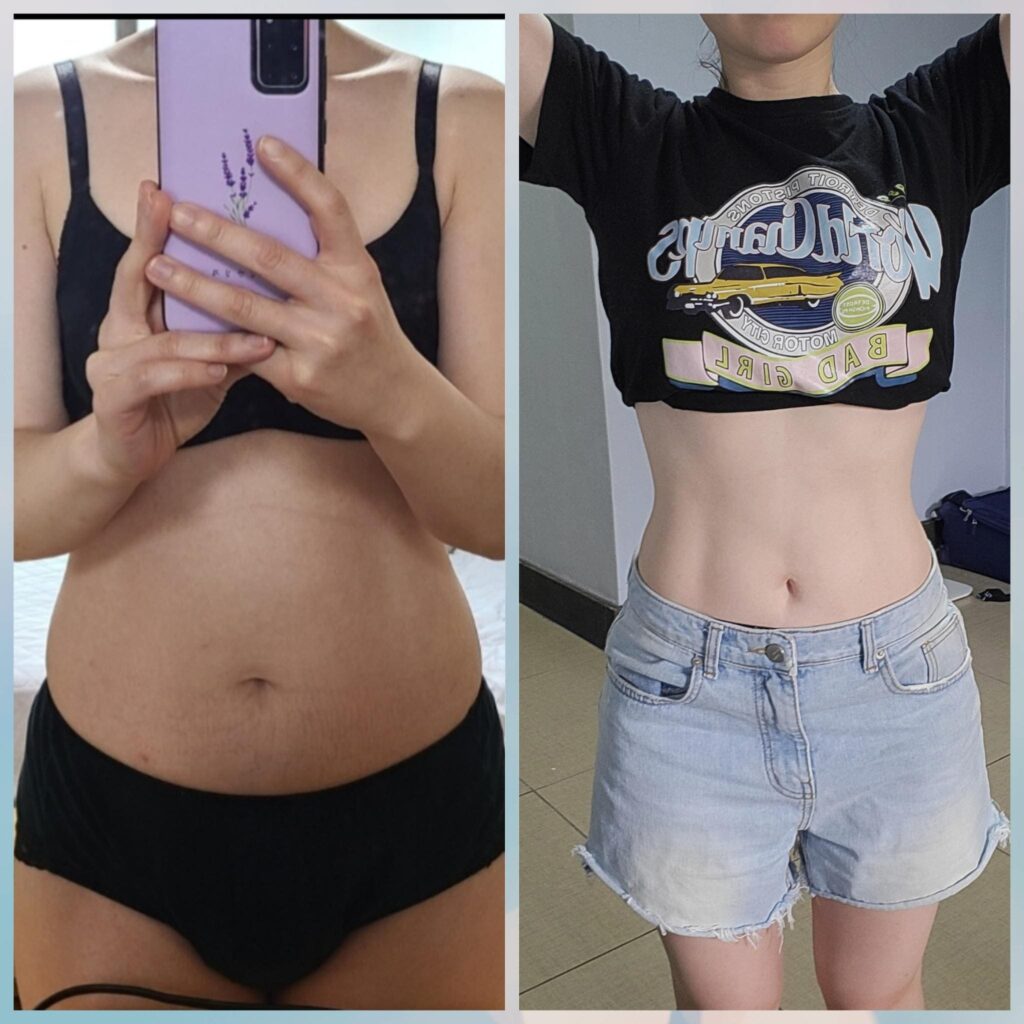 Optimal Age for Abdominal Liposuction in Korea