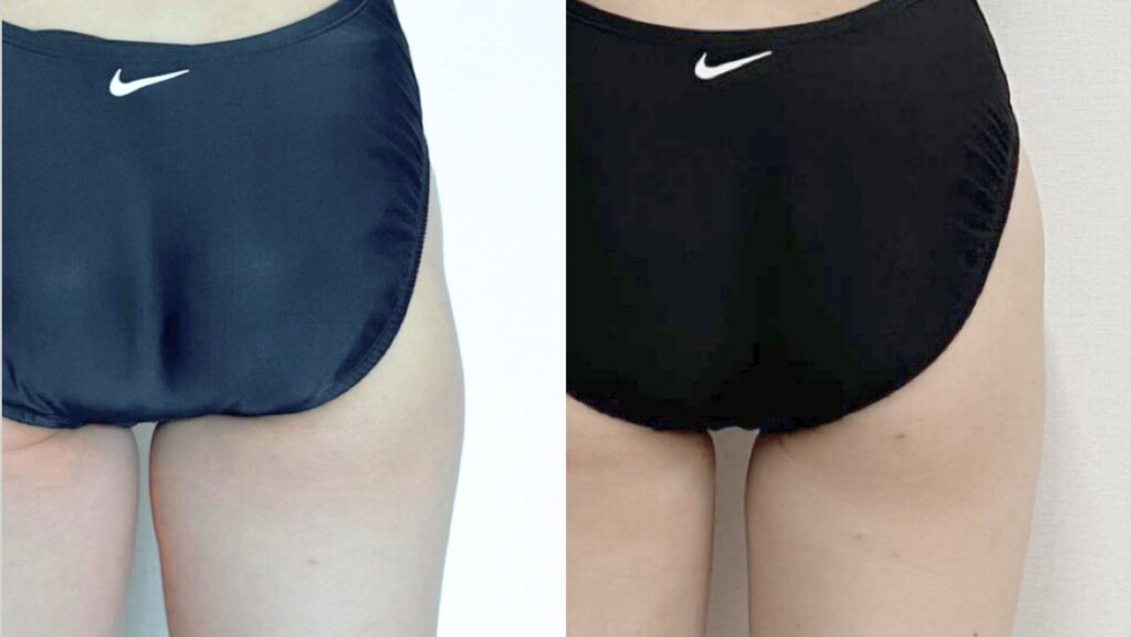 Optimizing Buttock Lipofilling Results