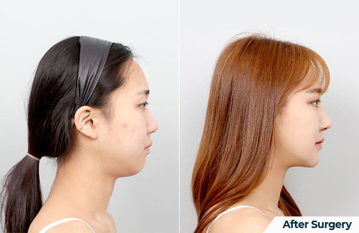 Optimizing Chin Shape for Symmetry in Korea