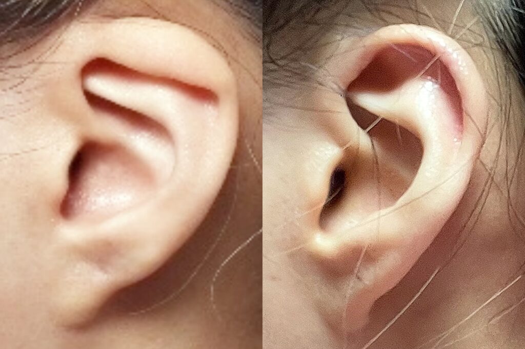 Otoplasty Before and After in Korea