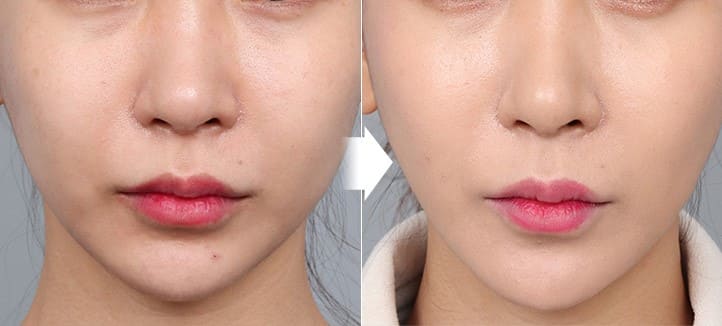 Overview of Face Lifting Clinics in Seoul