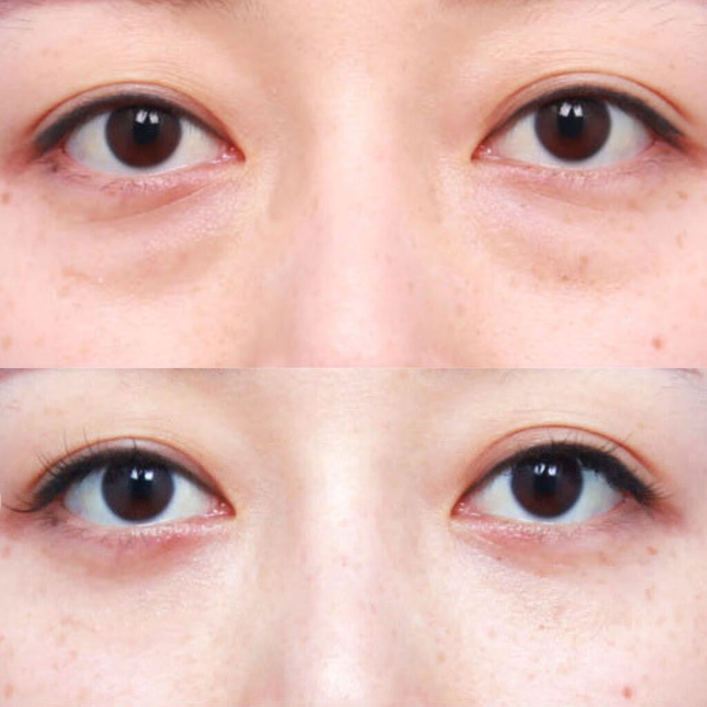 Painless Removal of Under-Eye Bags in Korea