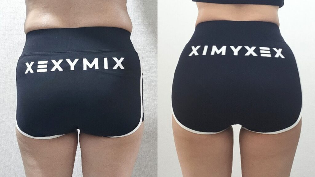 Patient Experiences After Buttock Lipofilling in Korea