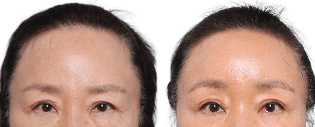 Patients After Forehead Lift in Korea