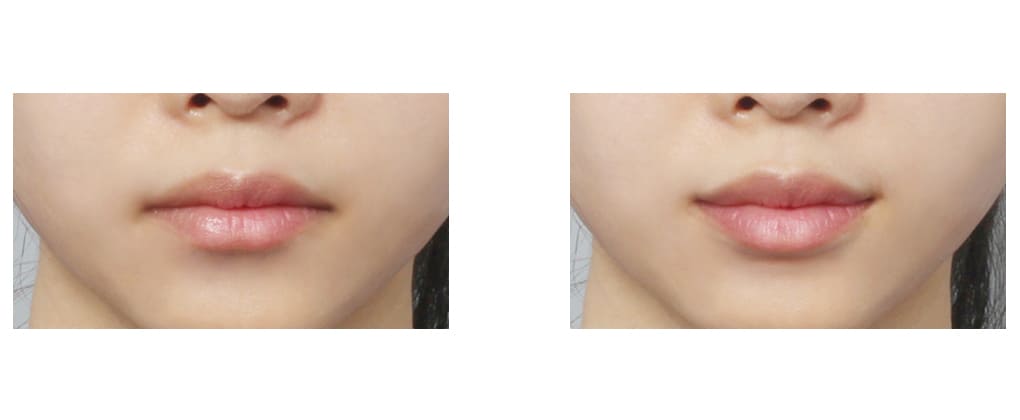 Perfect Lip Shape in Korea