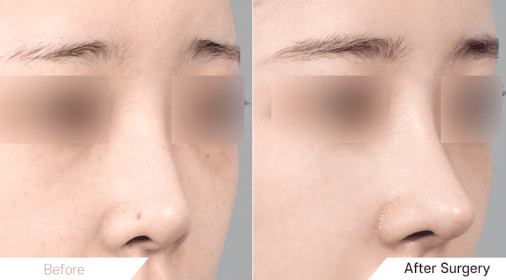 Perfect Profile_ Rhinoplasty for Short Noses in Korea