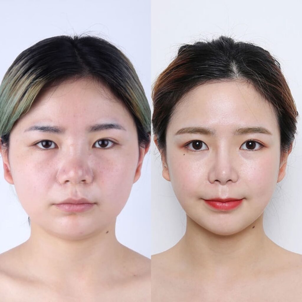 Perfecting Asian Nose in Korea