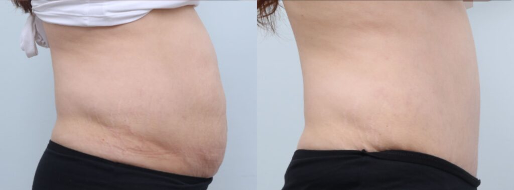 Personal Experience with Abdominoplasty in Korea