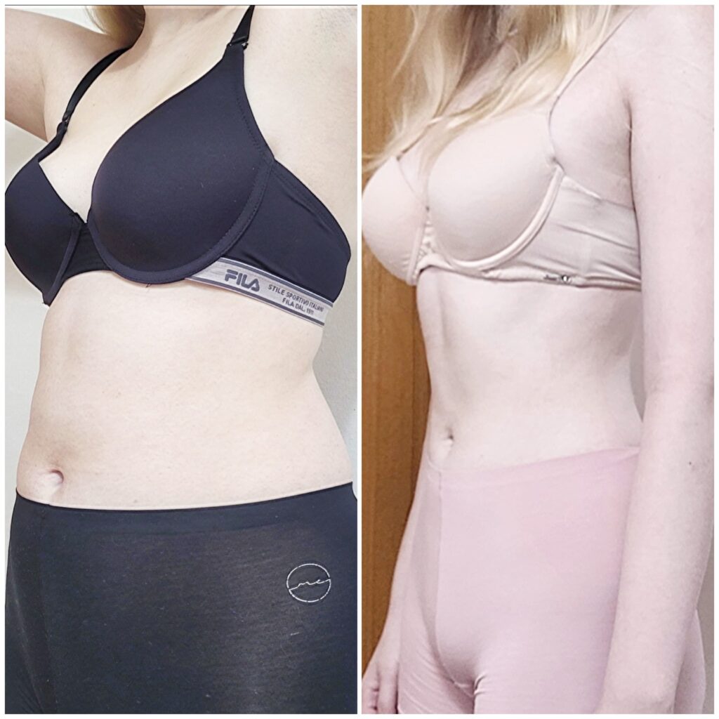 Personalized Approach to Abdominal Liposuction in Korea