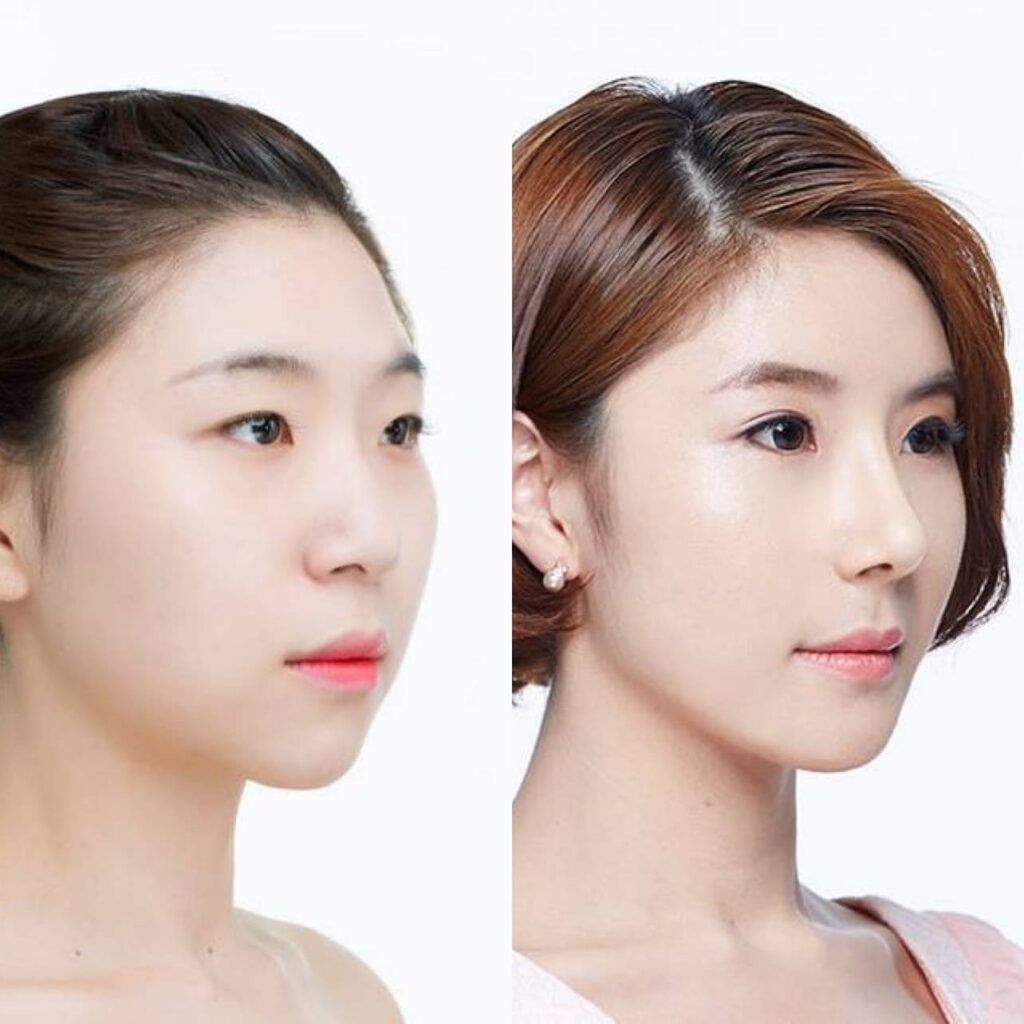 Personalized Asian Nose Enhancement in Korea