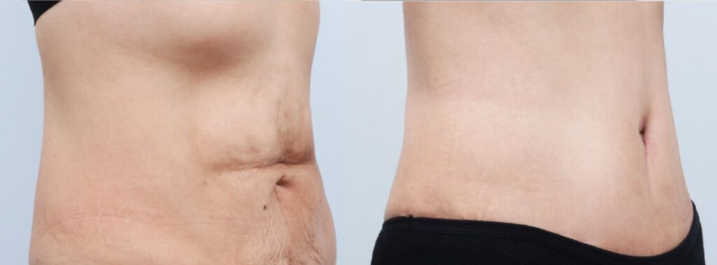 Planning for Abdominoplasty in Korea