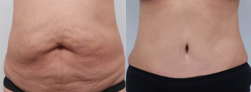 Post-Abdominoplasty Care in Korea