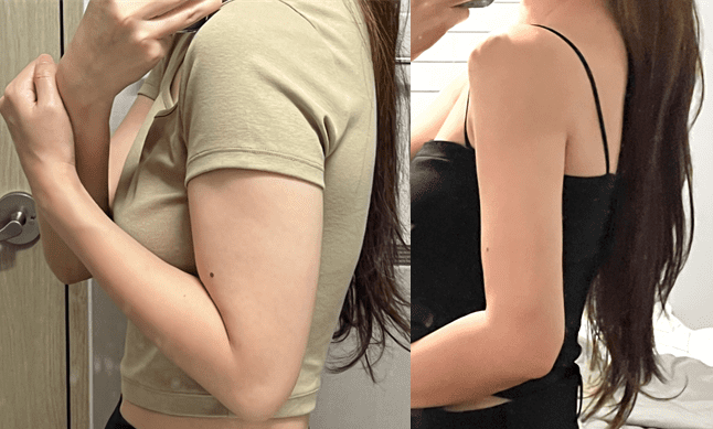 Post-Arm Liposuction Tips in Korea