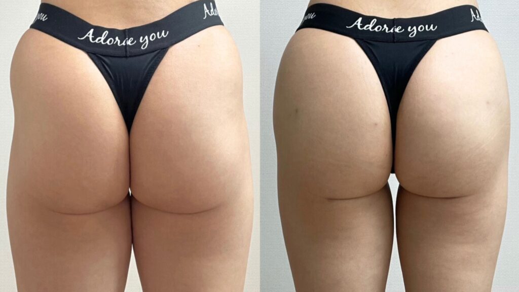 Post-Lipofilling Buttock Care Tips