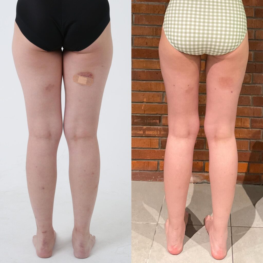 Post-Operative Care for Calf Liposuction in Korea