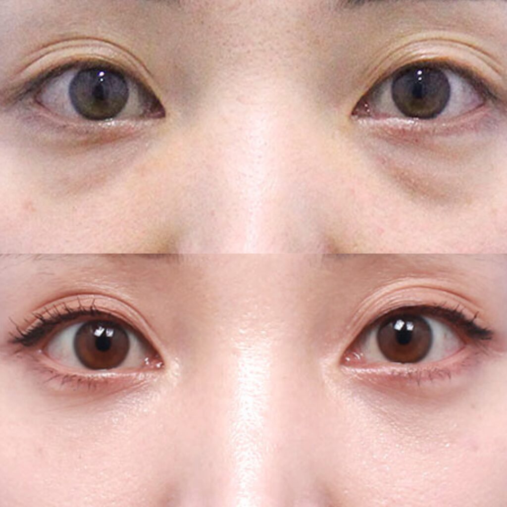 Post-Procedure Blepharoplasty Recommendations in Korea