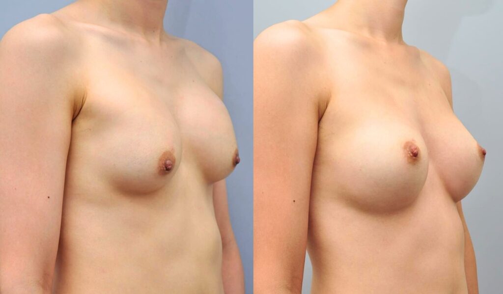 Post-Surgery Care_ Essential Tips for Breast Augmentation in Korea