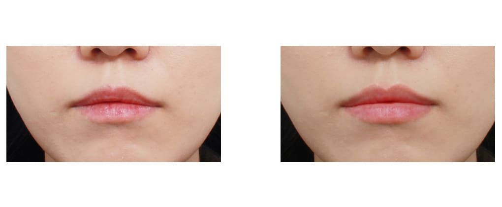 Postoperative Care for Lips in Korea