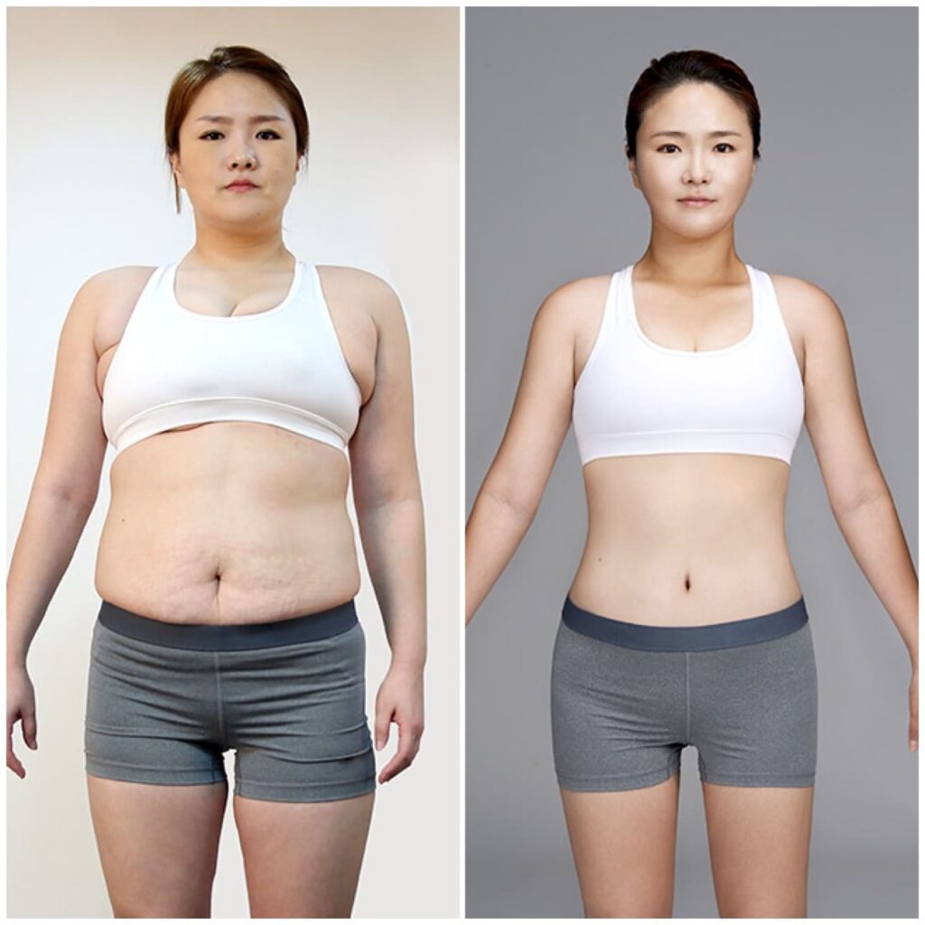 Postoperative Period of Abdominal Liposuction in Korea