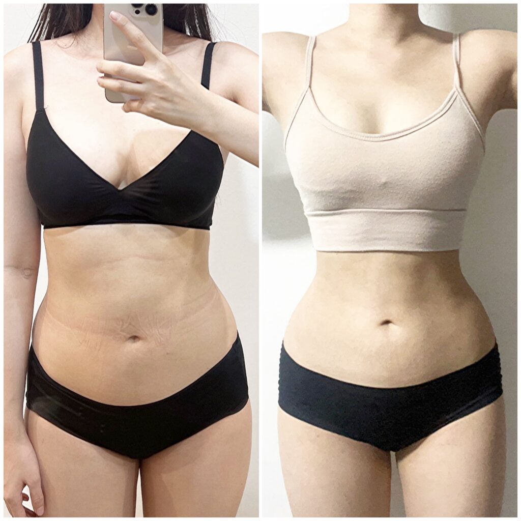 Preparing for Abdominal Liposuction in Korea