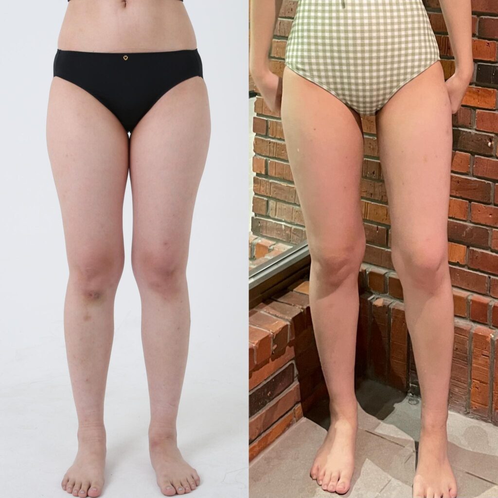 Preparing for Leg Liposuction in Korea