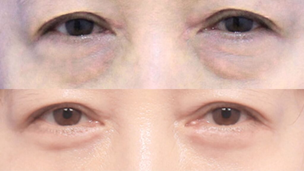 Preparing for Lower Blepharoplasty in Korea