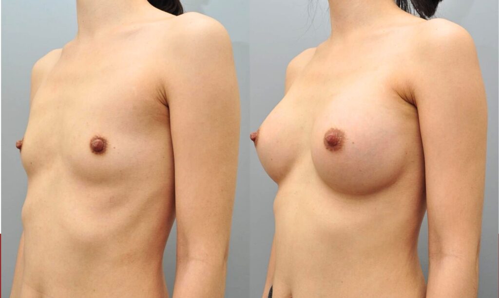 Preparing for Your Breast Augmentation Operation in Korea