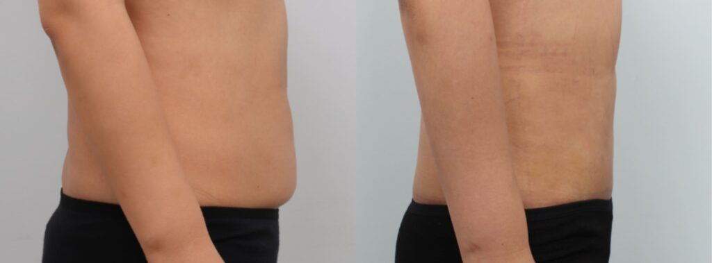 Prices for Abdominoplasty in Korea