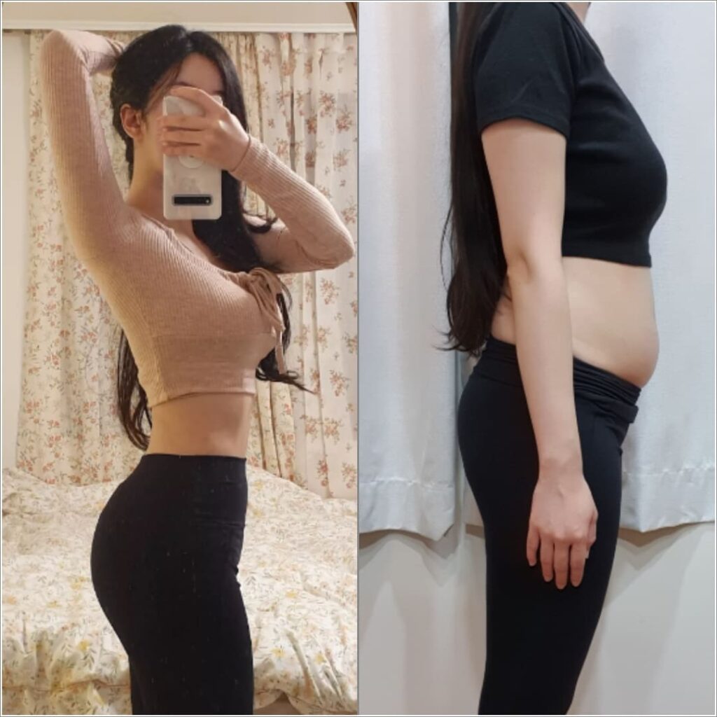 Process of Abdominal Liposuction in Korea