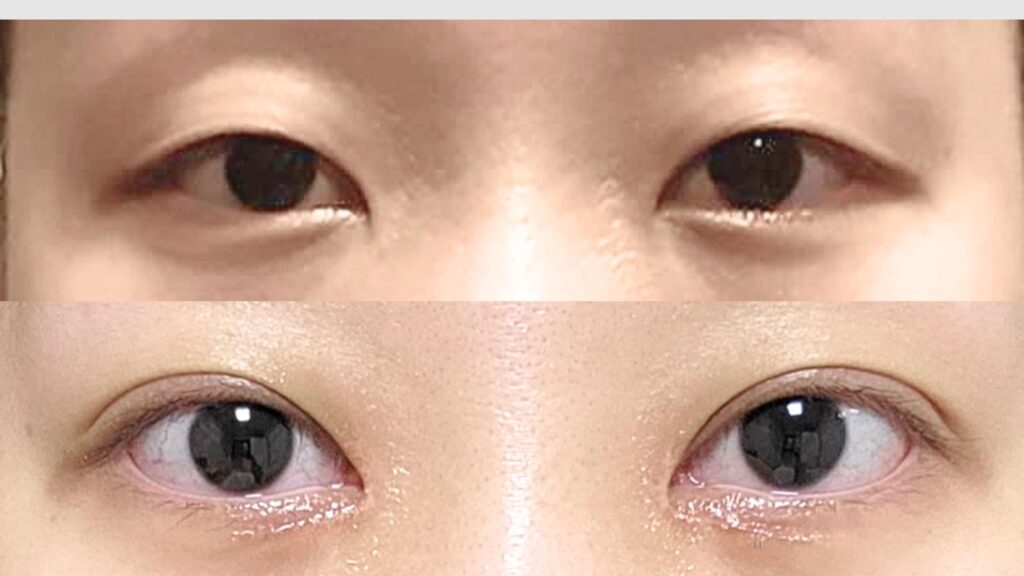 Pros and Cons of Asian Blepharoplasty in Korea