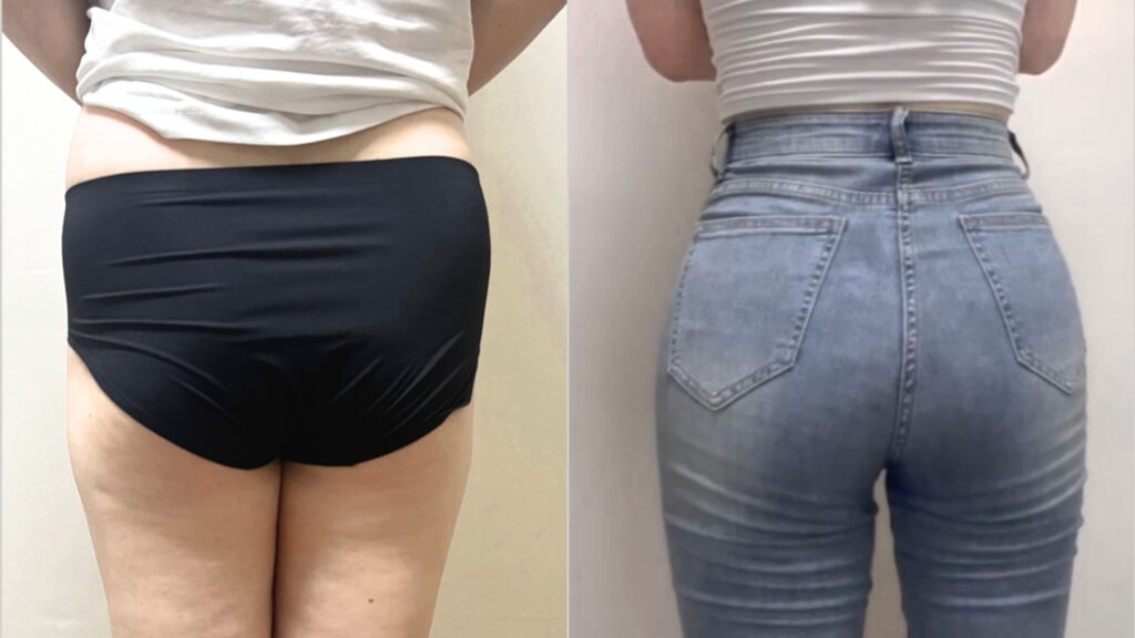 Pros and Cons of Buttock Lipofilling in Korea