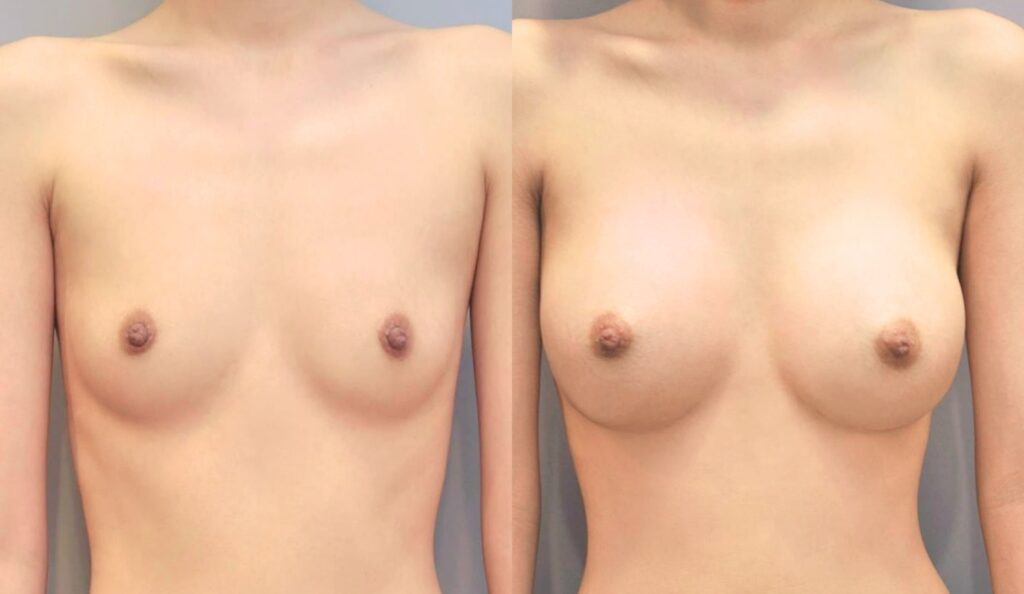 Psychological Aspects of Breast Augmentation in Korea