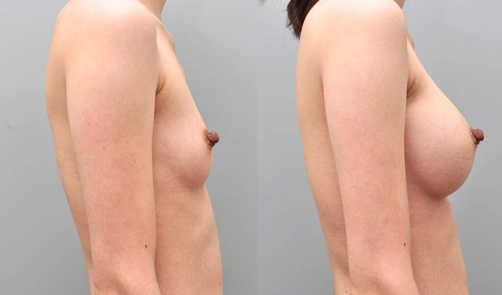 Real Reviews on Breast Augmentation in Korea