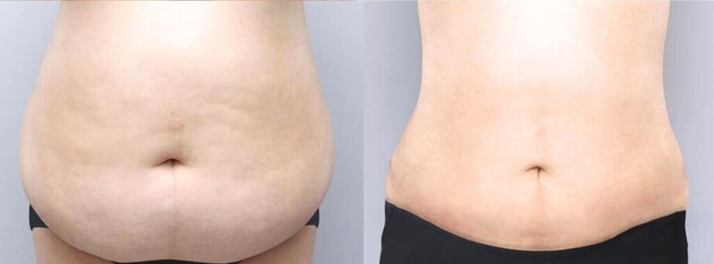 Recovery After Abdominoplasty in Korea