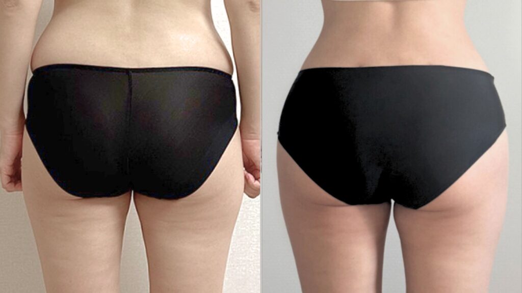 Recovery After Buttock Lipofilling in Korea