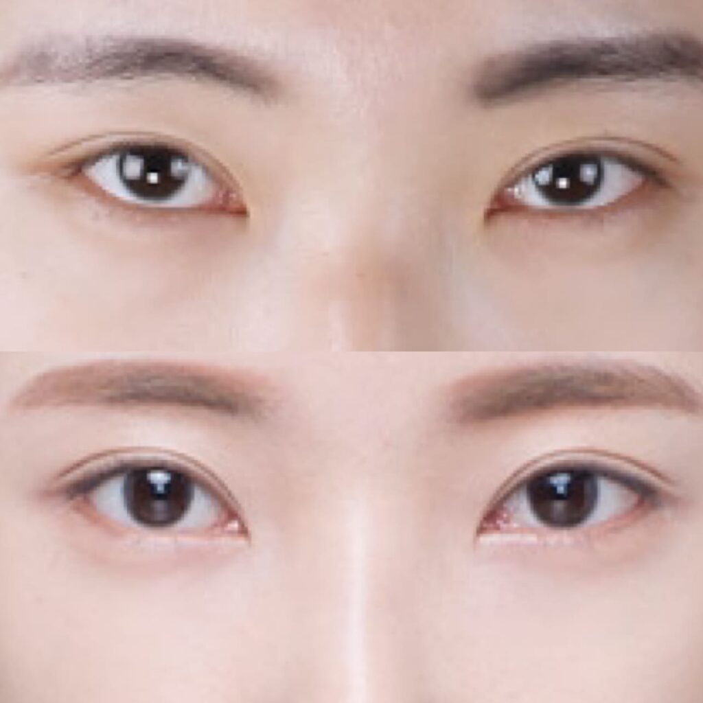 Recovery After Canthoplasty in Korea